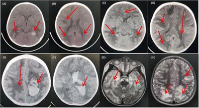 Case report: Non-EBV associated cerebral vasculitis and cerebral hemorrhage in X-linked lymphoproliferative disease